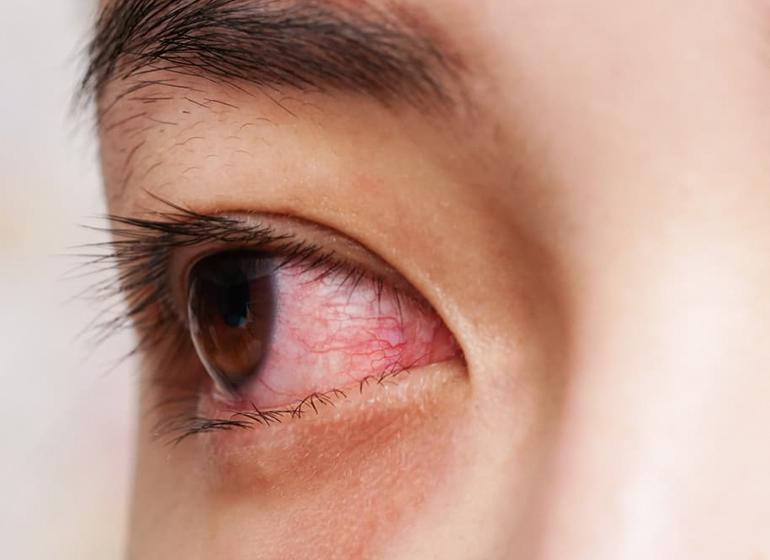  Mata Belekan Terlalu Sering, Berbahayakah?