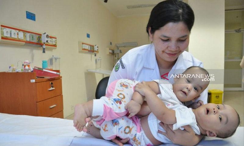  Bayi Kembar Siam Dempet Adam dan Malik Mulai Jalani Operasi