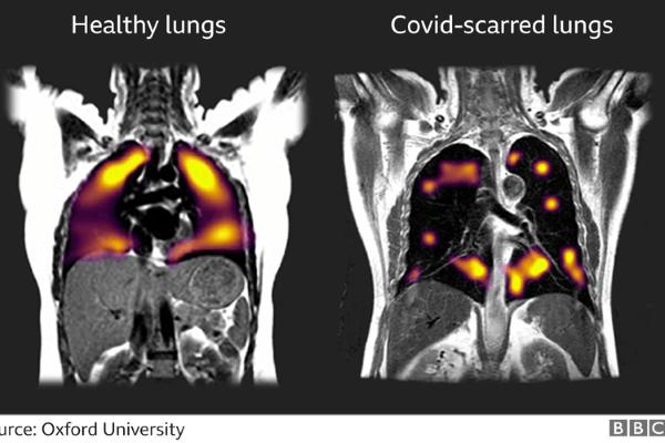  Pasien pascaCOVID-19 Miliki Risiko Paru yang Lebih Rentan