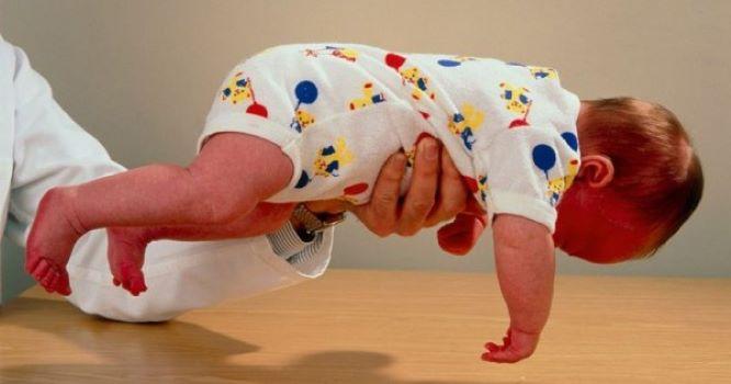  Bayi Terkulai Lemas Bisa Jadi Gejala ‘Cerebral Palsy’