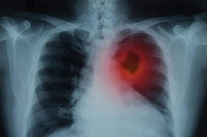  88 Persen Pasien Kanker Paru, Wafat di Tahun yang Sama saat Kanker Ditemukan