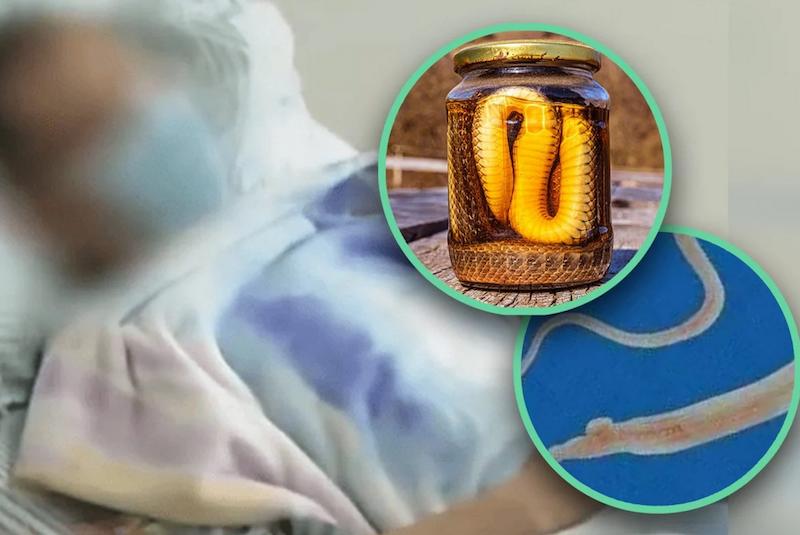  Mengerikan! Gara-gara Makan Empedu Ular, Pria Ini Lumpuh karena Parasit Berkembang di Sumsum Tulang Belakang