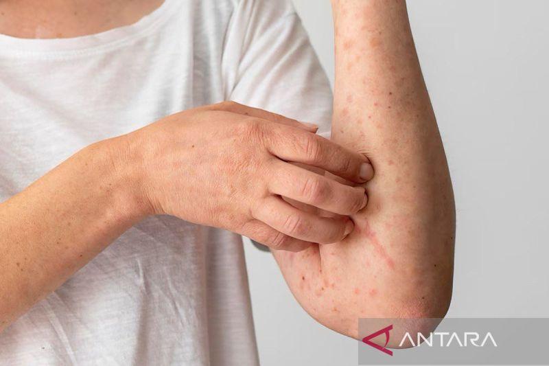  Tidur Cukup, Kurangi Risiko Terkena Penyakit Lupus