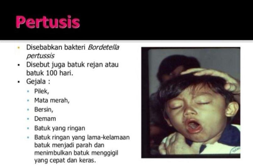  Ini Bahaya yang Mengintai Jika Pertusis Tidak Segera Diobati